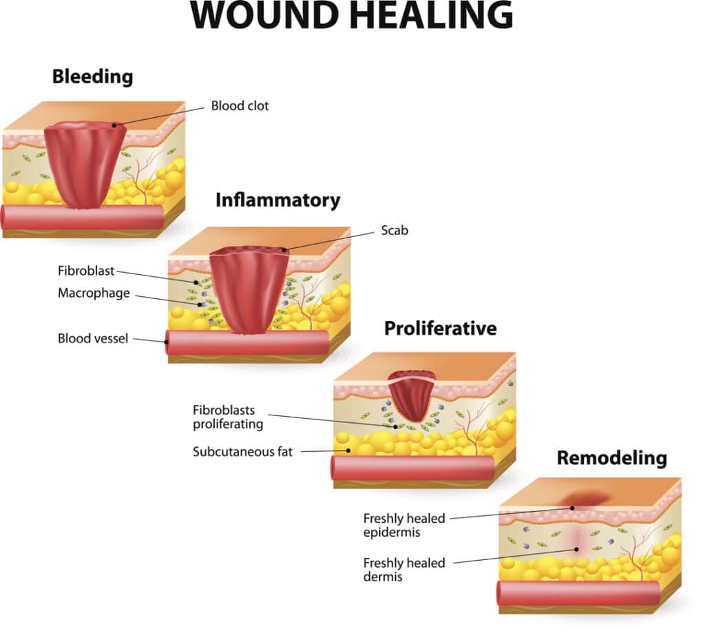 Hyperbaric Oxygen Therapy Chambers wound healing picture showing various stages